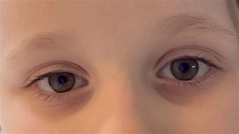 toddler dark circles under eyes iron